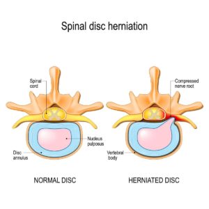 Non-Surgical Treatments for Herniated Discs - Texas Spine Clinic