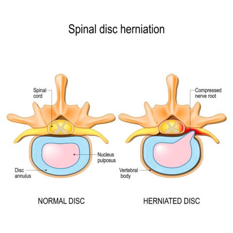 Non-Surgical Treatments for Herniated Discs - Texas Spine Clinic