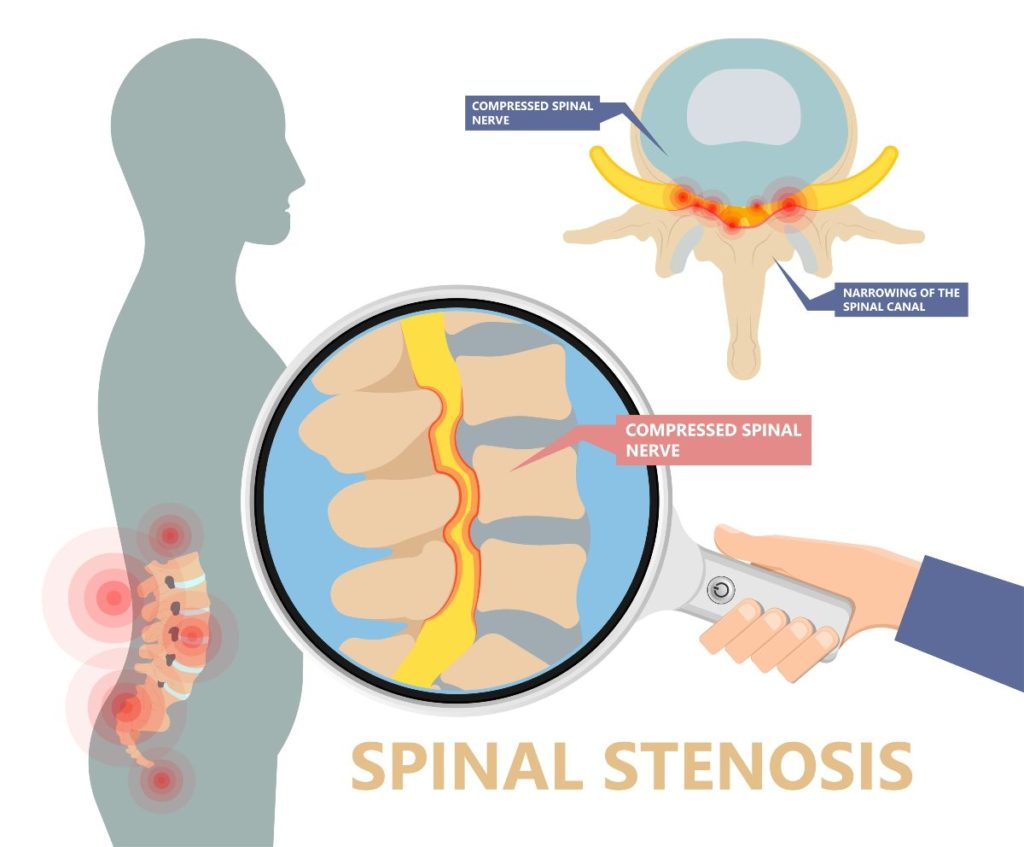 Nine Spinal Stenosis Treatment Options to Help with Pain
